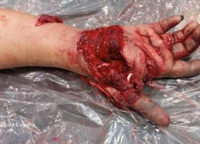 پیوند انگشتان قطع شده جوان 17 ساله در یزد